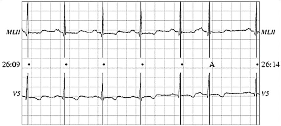 Figura 1: Representação de uma onda normal de um ECG. desenvolver fibrilação ventricular espontânea, o que é letal [4]. A Figura 3 mostra um trecho de captura onde ocorre uma CPV.