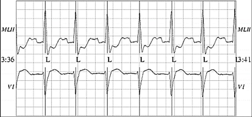 Em geral, as arritmias podem ser causadas por uma ou mais anormalidades no ritmo do coração [3], sendo o ECG o melhor e mais confiável diagnóstico.