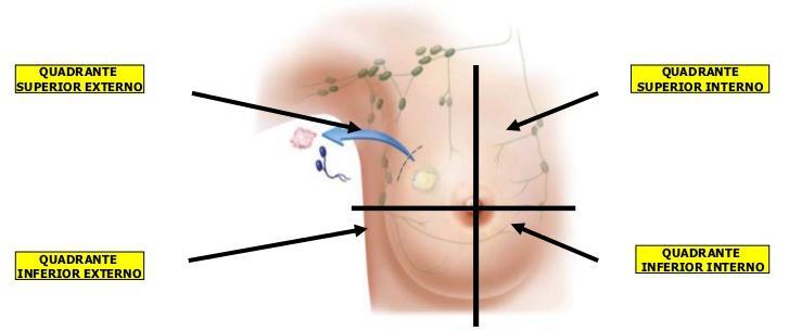 Topograficamente, as mamas são divididas em quadrantes superiores (lateral e medial), inferiores (lateral e medial) e