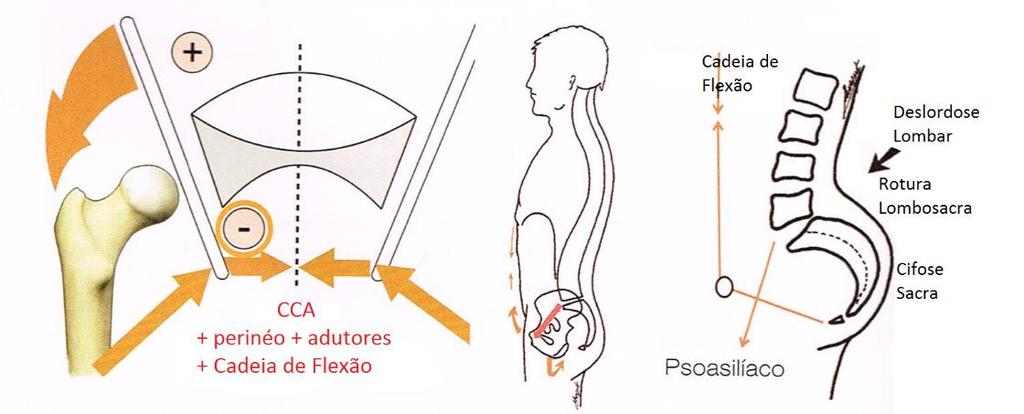 - Se a origem é pélvica, à cadeia de flexão (CF) se associa a CCA.