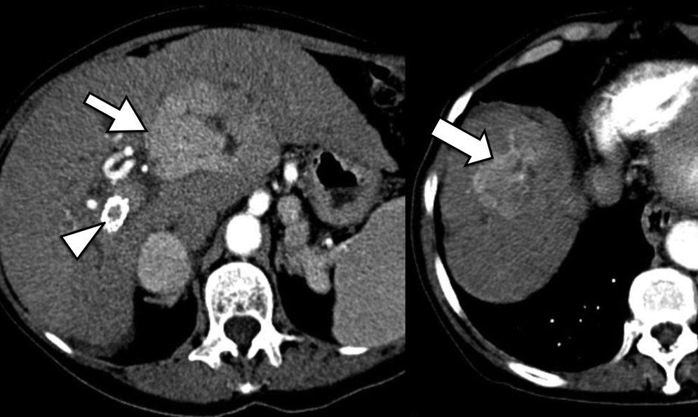 Fig. 2 - Carcinoma hepatocelular em fígado cirrótico. TC em fase arterial demonstra um nódulo hipercaptante. Como é uma lesão única, com 2,5cm, o paciente é candidato a transplante. Fig.