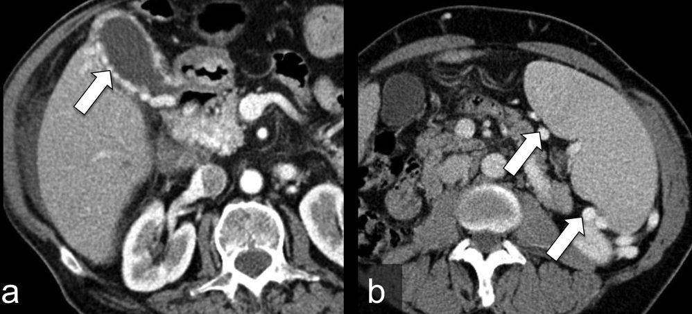 Fig. 7 - Imagens axiais de TC com contraste em diferentes pacientes demonstram varizes peri-vesiculares (a) e peri-esplénicas (b). Fig.