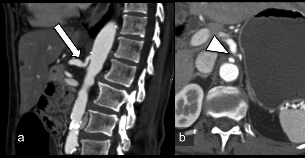 Imagens de TC na fase arterial, no planos sagital (a) e axial (b), demonstram tortuosidade do tronco celíaco proximal (seta), associada a dilatação pós-estenótica.
