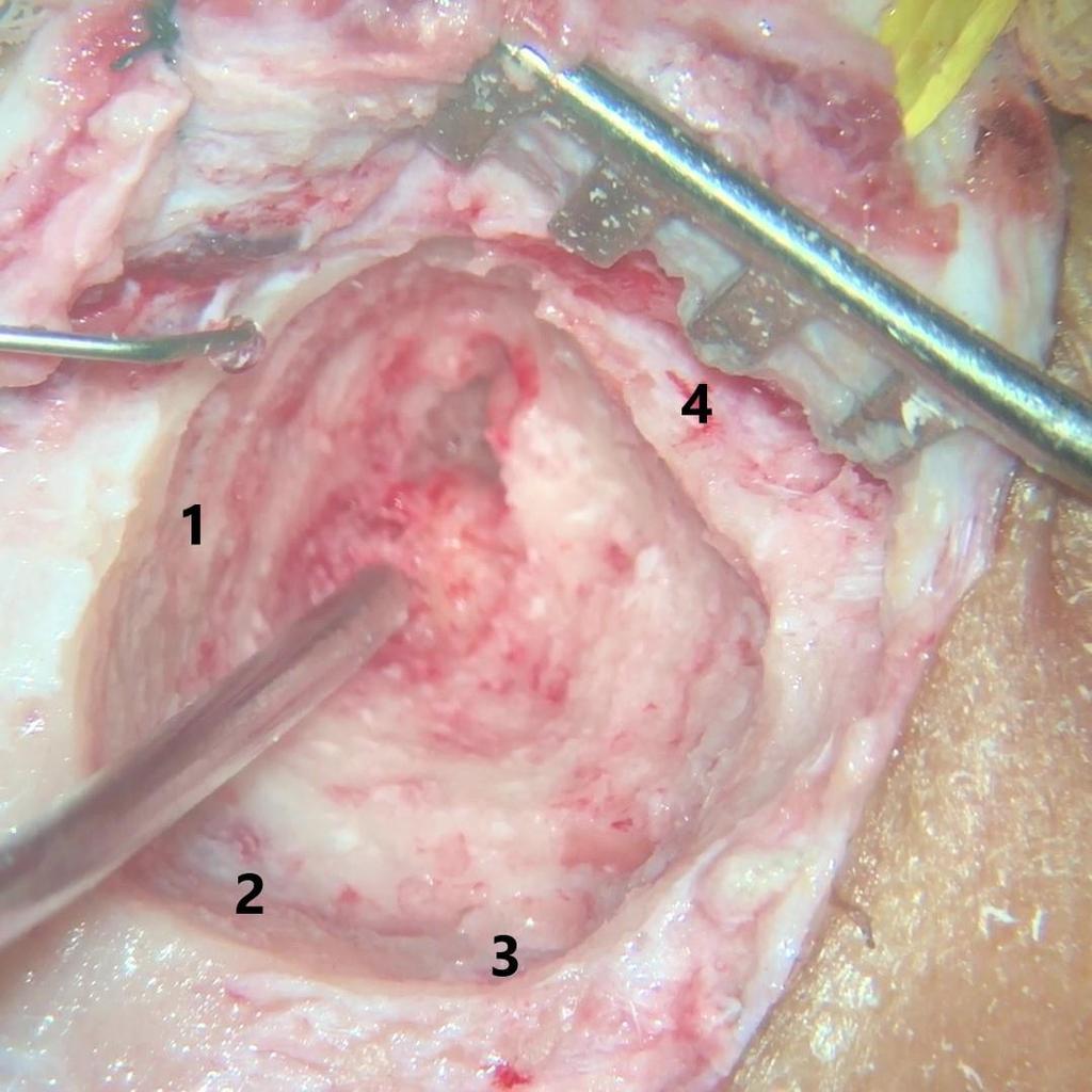 5 Resultados 46 Figura 7 - Mastoidectomia ampla delimitando fossa média (1), ângulo sinodural (2) e seio sigmoide (3), preservando o teto da placa atrésica (4) do osso timpânico