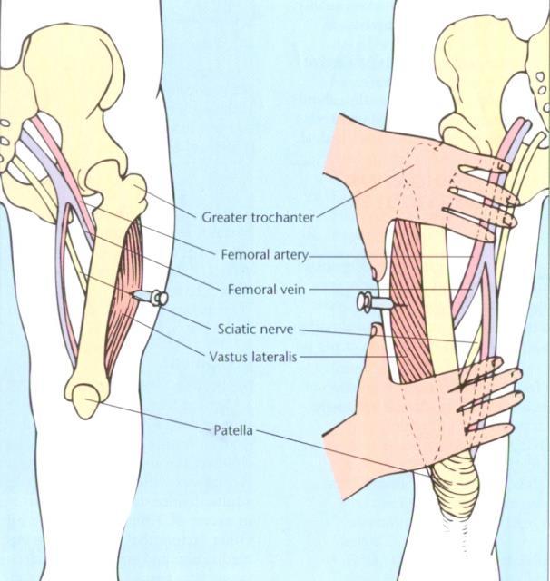 vasos sanguíneos ou nervos importantes, porém associada à lesão do nervo e da artéria femorais