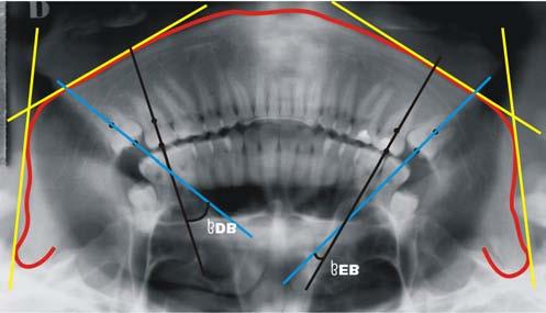1 (1977) onde a determinação do grau de inclinação do terceiro e segundo molares inferiores resulta da intersecção de dois eixos longitudinais sobre estes dentes.