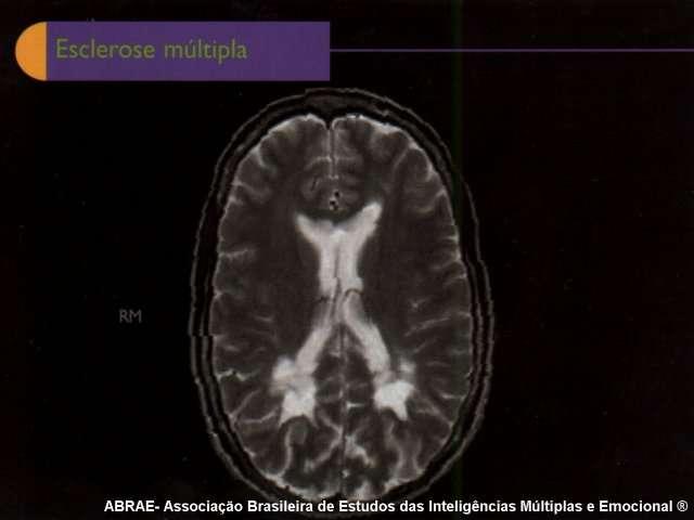 PRINCIPAIS DISTÚRBIOS DO SIST. NERVOSO Esclerose múltipla: uma doença auto-imune.