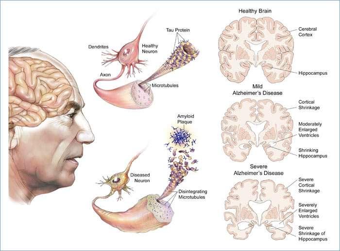 PRINCIPAIS DISTÚRBIOS DO SIST. NERVOSO Alzheimer: Formação defeituosa de uma proteína (tau) levando a destruição dos neurônios.