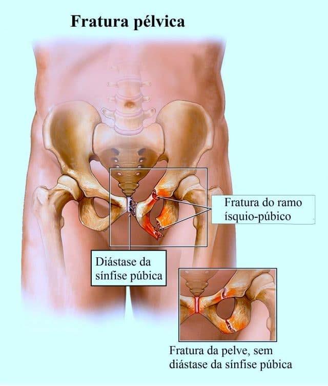 Choque sem causa evidente ASSUMIR O paciente está sangrando em algum lugar, mesmo que você não possa ver. Hemorragia interna tórax e abdome pode acumular grandes volumes de sangue.