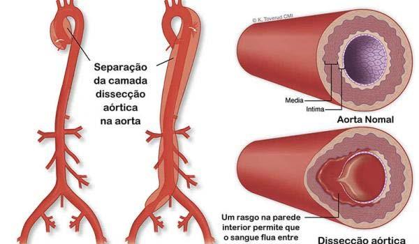 Lesões mais frequentes associados a choque hemorrágico Ruptura traumática de aorta (esgarçamento): ocorre geralmente na junção das porções