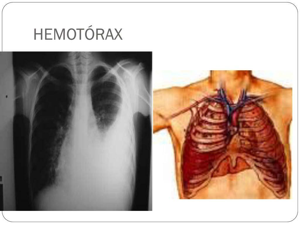 Hemotórax Trauma fechado ou penetrante Sangramento para
