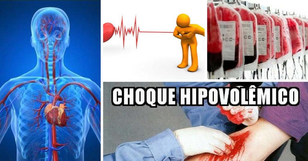 CHOQUE HIPOVOLÊMICO Quando ocorre perda aguda de sangue em virtude de desidratação (perda de plasma) ou de hemorragia (perda de plasma e hemácias), há