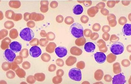 Figura 2. Lâmina de sangue periférico na LLC Fonte: LORENZI, 2013. Depois do hemograma, o clone tumoral de linfócitos B deve ser confirmado por citometria de fluxo.