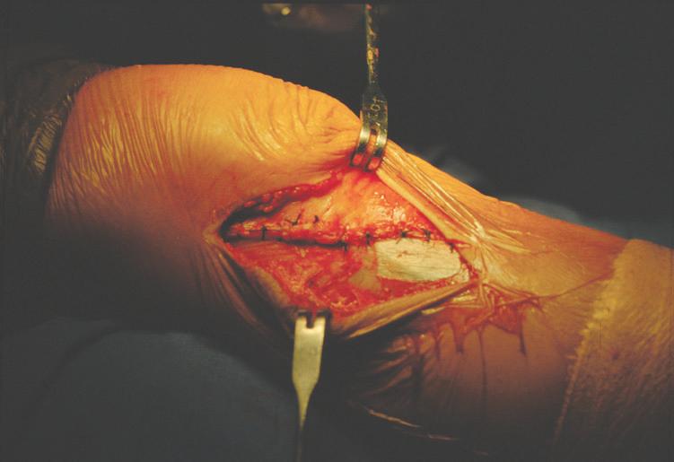 FIXAÇÃO DAS FRATURAS DO PLANALTO TIBIAL COM PARAFUSOS CANULADOS Conferida a redução da superfície articular e a estabilidade da fixação, inicia-se o fechamento da ferida (Figura 9).