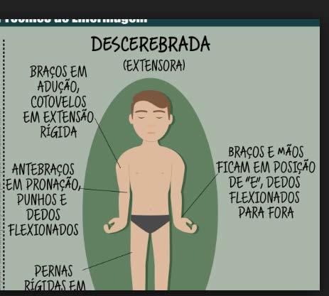 Descerebração: A Rigidez de descerebração ocorre em lesões do tronco encefálico e consiste na