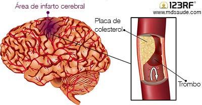 AVE ISQUÊMICO O AVE isquêmico é caracterizado por uma área de infarto cerebral devido à interrupção do fluxo sanguíneo, que acarreta em dano estrutural irreversível.
