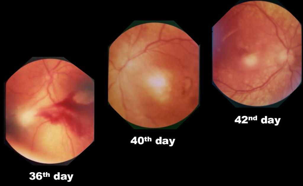 neurológicas (calcificações, dilatação ventricular): 21%