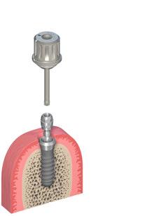 5 (RN e WN) limpo no octágono interno sem utilizar cimento. Em seguida aperte o parafuso do pilar com a chave de parafusos SCS juntamente com a catraca (046.