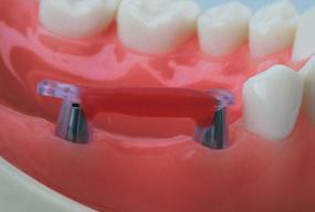 Retire os parafusos dos pilares do modelo mestre com uma chave de parafusos SCS e coloque a ajuda para transferência na boca do paciente.