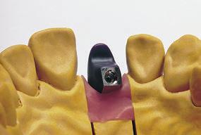 Use a chave de silicone do wax-up para verificar a forma da estrutura. A moldagem é efectuada num formato de dente de escala inferior.