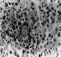 668 Arq Neuropsiquiatr 1998;56(3-B) Fig 3. Fotomicrografia mostrando neoplasia constituída de células poligonais com núcleos vesiculosos, nucléolos evidentes e mitoses, entremeada por linfócitos. H.E.