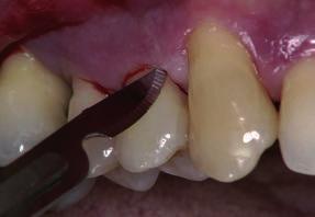 Neste caso em particular, existe um defeito estreito de 3 paredes numa posição distal em relação ao dente 14; por isso, o acesso cirúrgico processa-se por via bucal para a