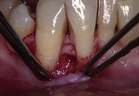 B5: Em alguns casos, é necessária uma incisão em bisel da papila do dente