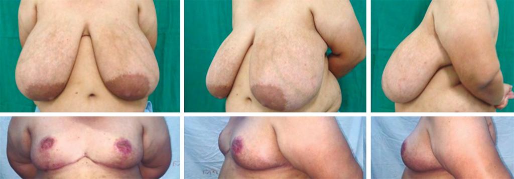 with great distance between the sternal notch and the nipple-areola complex, and comorbidities that change breast vascularization as well as any previous surgery that hinders the use of an areolar