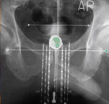 45 Figura 2 Radiografias semiortogonais da