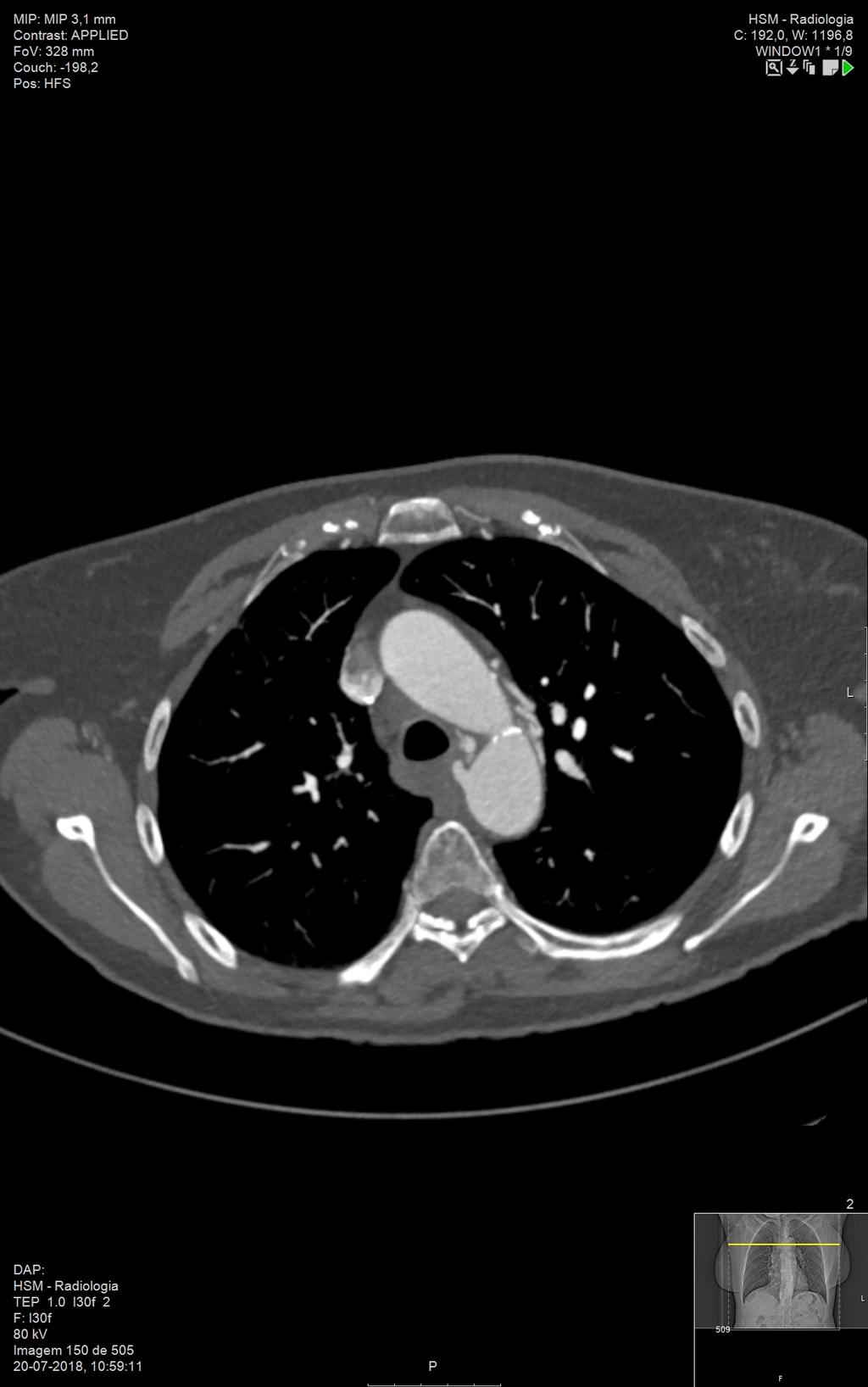 mm; APD>20 mm; APE>22mm) Hipertrofia das artéria brônquicas