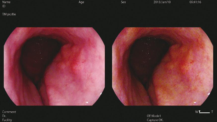 O uso de um endoscópio de magnificação com o filtro OE modo 1 permite reconhecer a i-scan de RT diferença na estrutura da superfície com a bordas evidente e a combinação deve ser efetiva para o