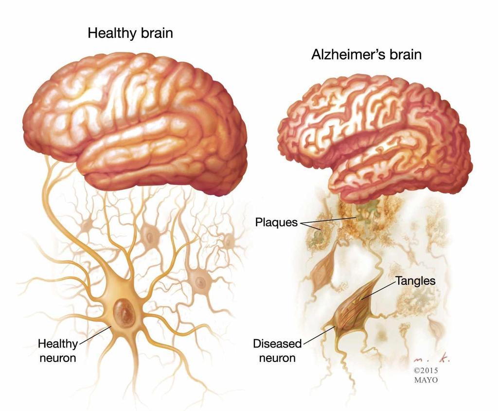 Histopatologia da Doença de Alzheimer Presença de grande número de
