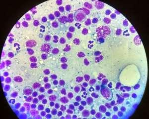 56 Fotografia 2 - Presença de neutrófilos e a forma amastigota da Leishmania spp parasitando macrófagos na objetiva 40x, corada com kit panótico rápido LaborClin Fonte: Arquivo pessoal.