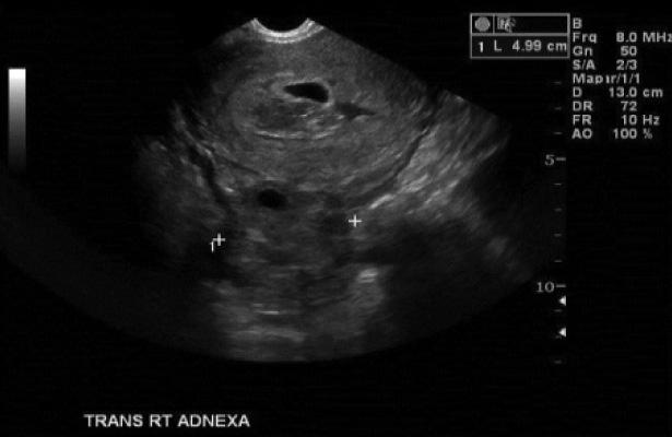 Gravidez Heterotópica: Gestação combinada extra e intra uterina Unusual