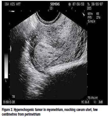 Gravidez Intramural: Gravidez circundada pelo miométrio e dentro da parede uterina com separação da cavidade uterina Tratamento com dose única de