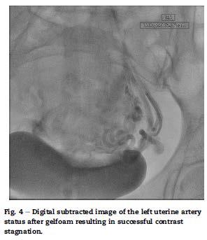 Embolização das artérias uterinas em gravidez cervical Vantagem: curetagem posterior a embolização diminui risco de sangramento após restabelecimento da vascularização Pode ser