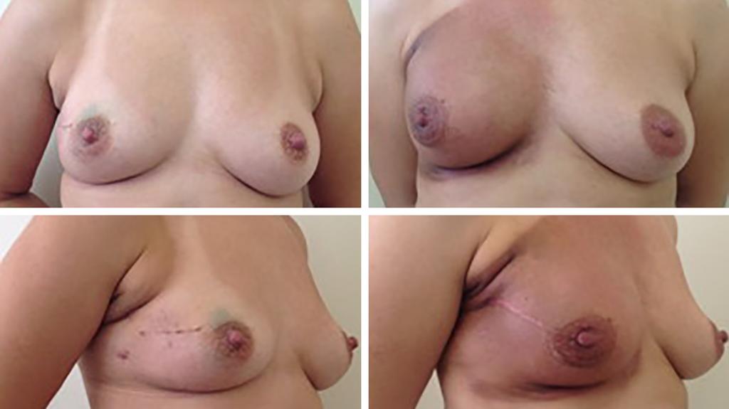 Reconstrução imediata de mama com uso de expansores permanentes Tabela 1. Complicações. Complicações n de pacientes Tratamento realizado Necrose da pele F.O.