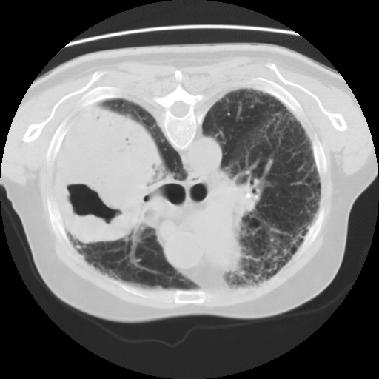 Fig. 6 - Volumoso nódulo, cavitado, com nível hidro-aéreo, evidenciando parede com espessamento nodular.