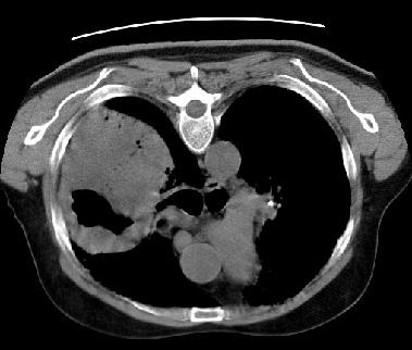 O cancro do pulmão pode também calcificar, tipicamente de uma forma amorfa e difusa, podendo ser punctiforme em algumas