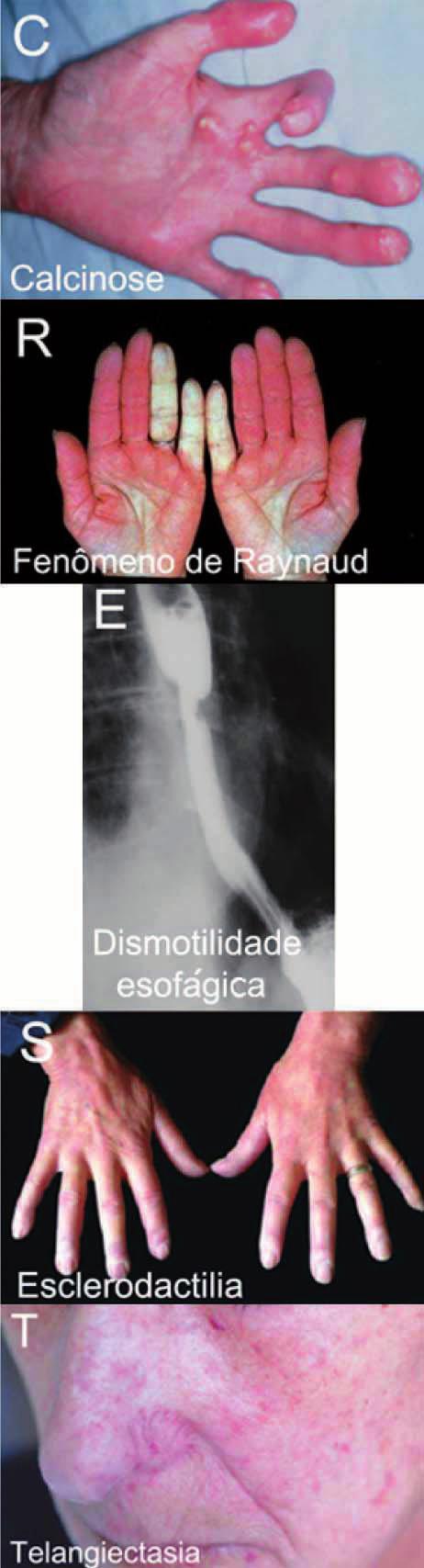 esclerose sistêmica 319 Formas clínicas Quadro pulmonar mais associado Anticorpo mais associado Prognóstico ES difusa Fibrose intersticial pulmonar Antitopoisomerase I Reservado, associado à