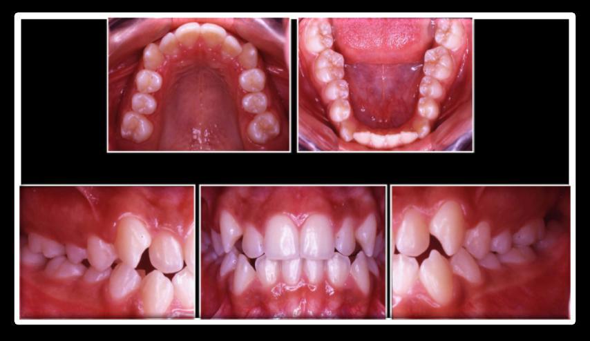 relação molar de Classe III bilateral, incisivos inferiores inclinados para lingual como uma adaptação da relação