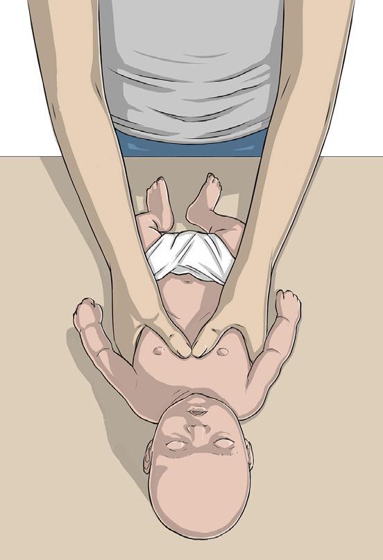 Técnica do Abraço No caso de estarem presentes dois reanimadores, e se a estrutura física da criança o permitir, deve ser usada preferencialmente a técnica de compressão com os 2