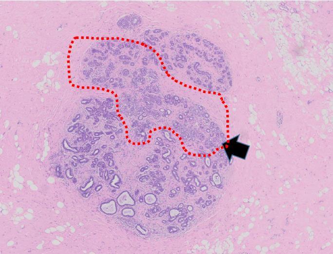 ALH LCIS < 50% UDLT > 50% UDLT