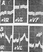 238 ARQUIVOS BRASILEIROS DE CARDIOLOGIA dos têm valor pequeno, como as diversas durações encontradas, pois são semelhantes às obtidas nos outros tipos de derivações, já tendo sido suficientemente