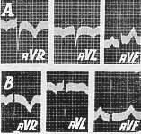 240 ARQUIVOS BRASILEIROS DE CARDIOLOGIA Fig. 2 - Formas de complexo QRS encontradas em avl, em corações de posição elétrica vertical.