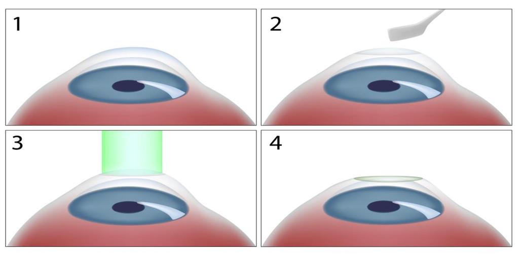 4 A B C D Figura 1. Esquema da ceratectomia fotorrefrativa (PRK). Em A, córnea com epitélio íntegro. Em B, desepitelização da córnea. Em C, fotoablação. Em D, córnea no pós-operatório imediato.