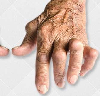 Artrite Reumatóide Doença autoimune na qual as células de defesa erroneamente atacam as articulações, causando inchaço, vermelhidão e dor nas juntas, em geral nas mãos, joelhos, tornozelos, punhos,