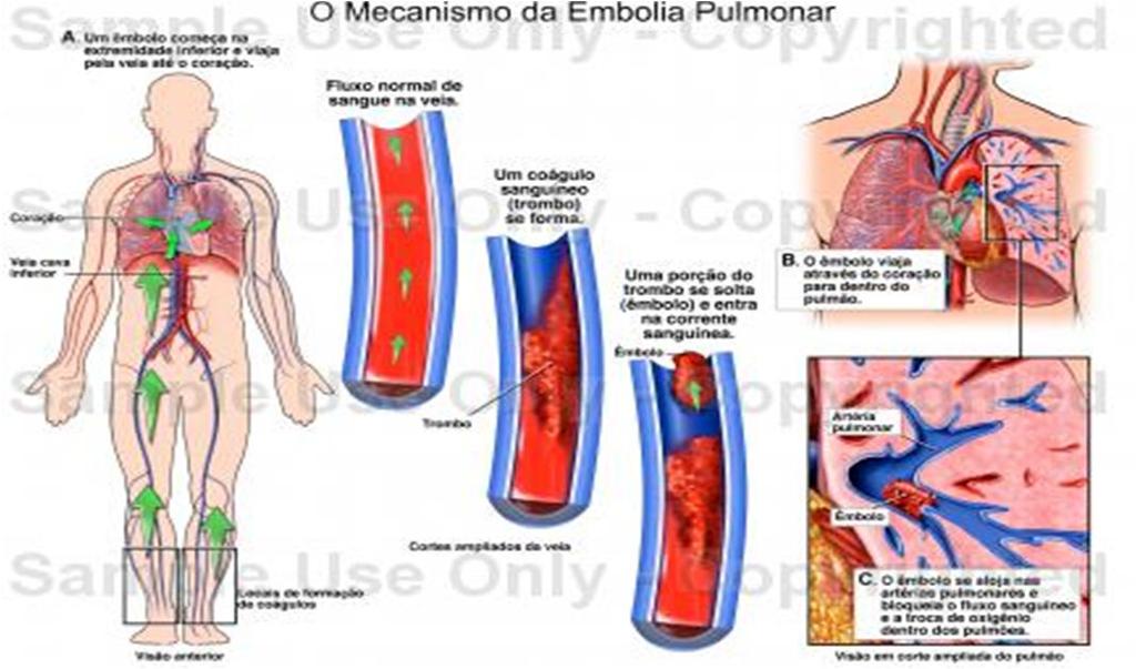 Embolia Pulmonar Embolo MMII Fluxo normal Trombo Embolo