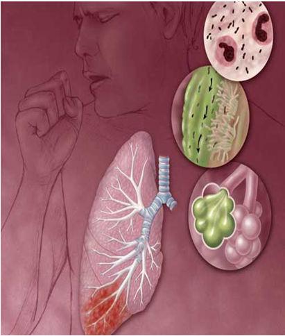 Manifestações clínicas Dispnéia Edema Dor torácica Tosse Cianose Hemoptise Síncope Cansaço Palpitações Hemoptise Expectoração sanguinolenta por meio da tosse, proveniente de hemorragia na árvore