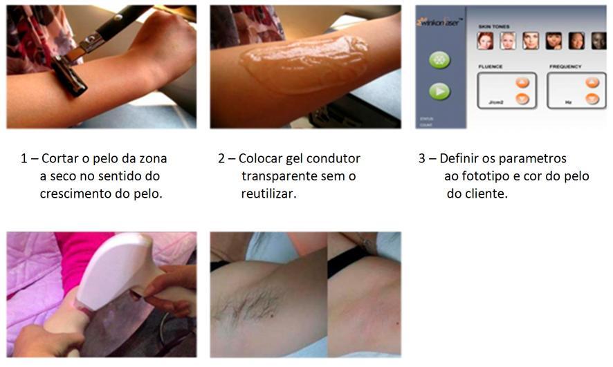 6 Depois do tratamento, retirar o gel ao cliente com a espátula e limpar com um papel macio. 7 Aplicar gel pós depilatório/regenerador. 8 Limpar o equipamento.